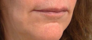 Chin Fillers