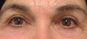 Lower and Upper Lid Blepharoplasty