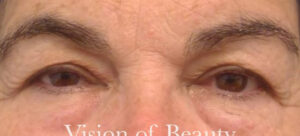 Lower and Upper Lid Blepharoplasty