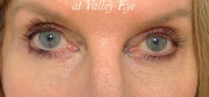 Lower Lid Blepharoplasty