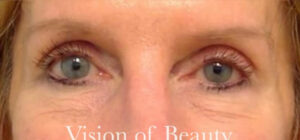 Lower Lid Blepharoplasty