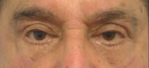 Lower and Upper Lid Blepharoplasty