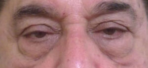 Lower and Upper Lid Blepharoplasty