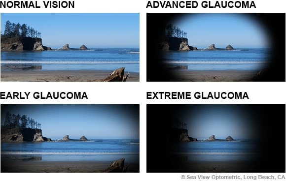 what glaucoma looks like