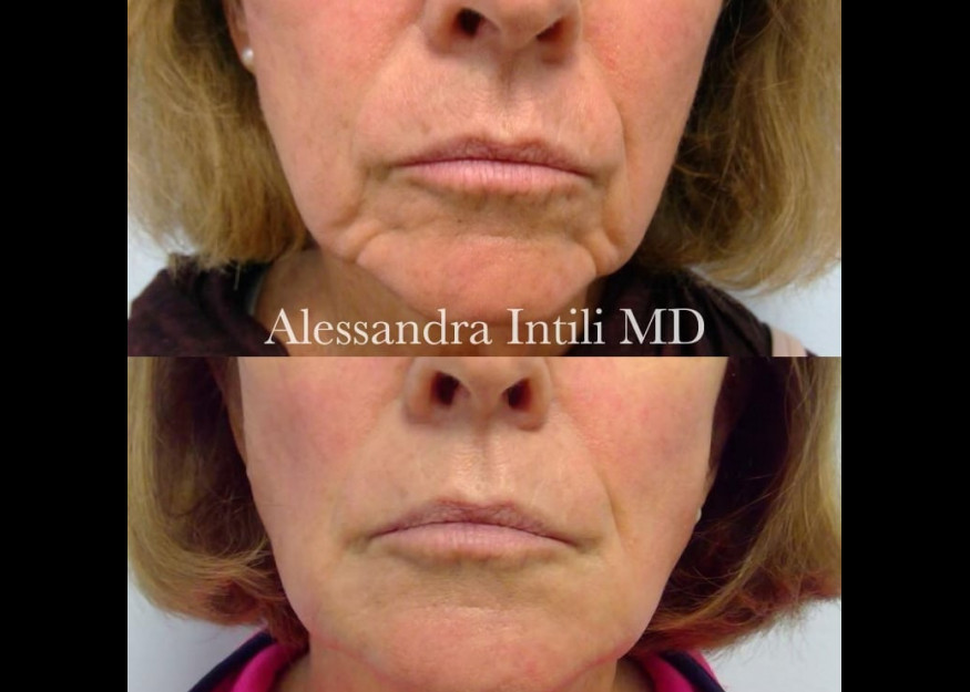 Chin Fillers