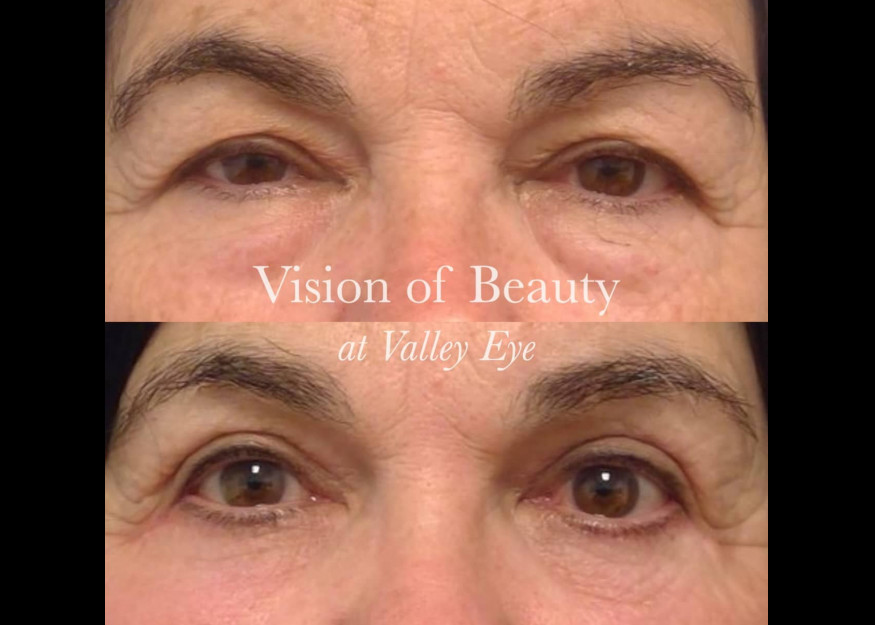 Lower and Upper Lid Blepharoplasty